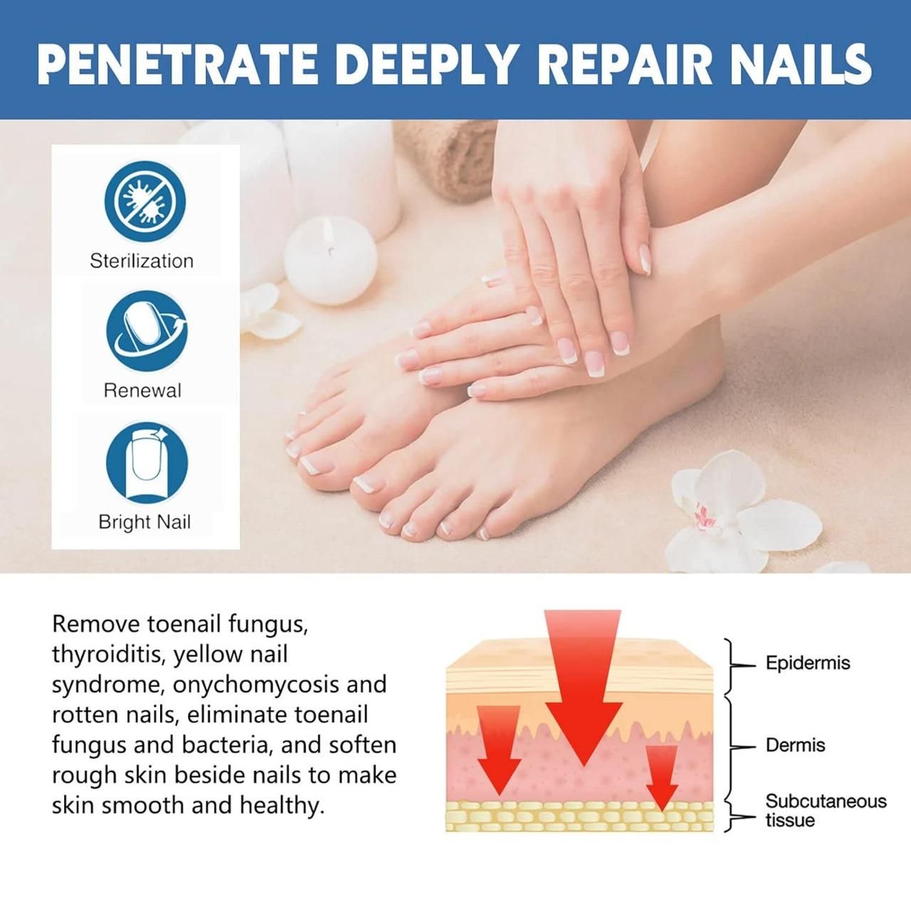 Nail Fungus Treatment Cream 100gm (Pack Of 1)